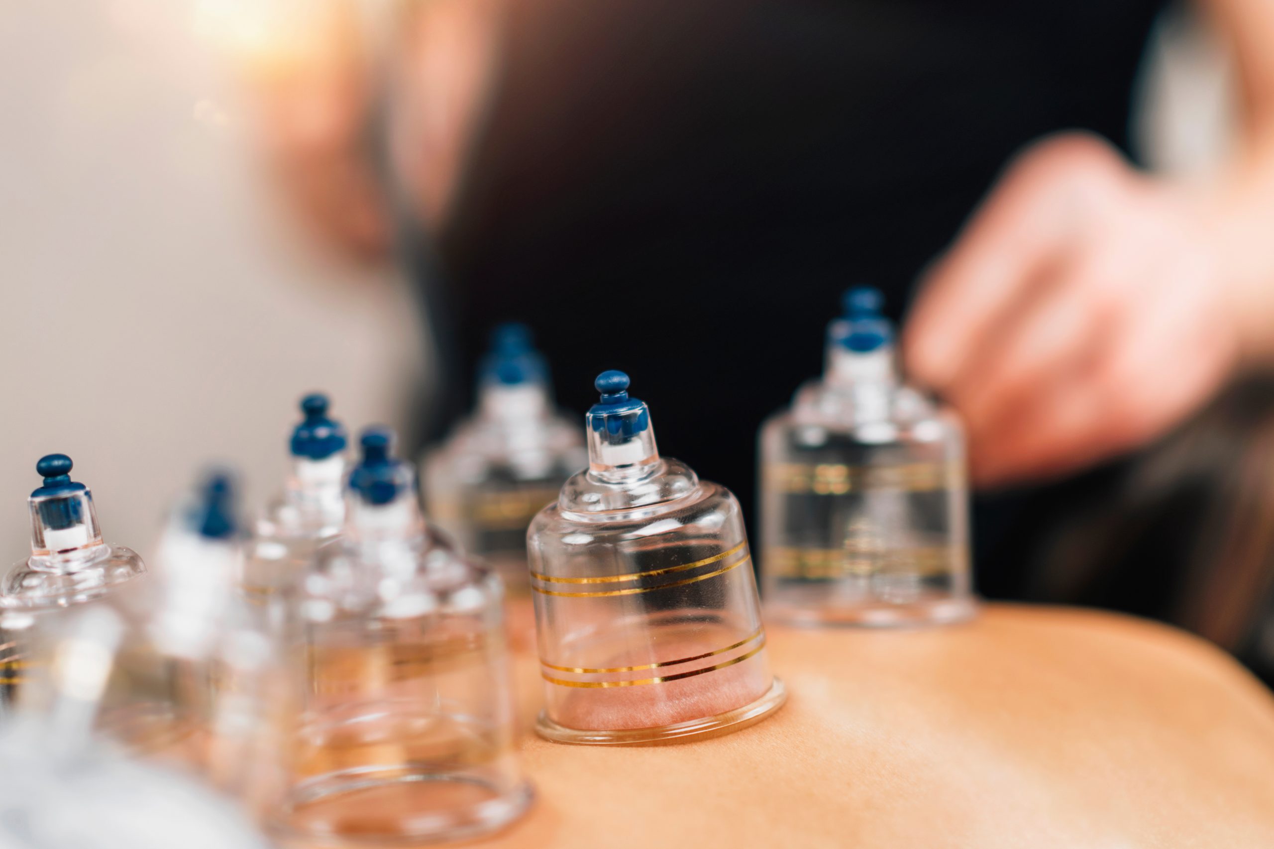Cupping Therapy on Women’s Back